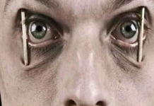 যে রোগ হলে একটু সময়ের জন্য ঘুমালেই মারা যাবে মানুষ ঘুমালেই মারা যাবে মানুষ, Ondine's curse,